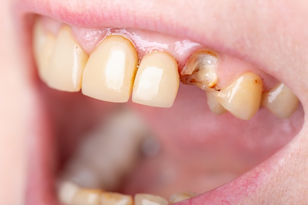 Treatment Options For A Chipped Tooth