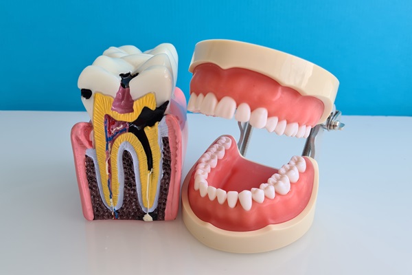 When To Seek Treatment: Signs That You Might Need A Root Canal Specialist